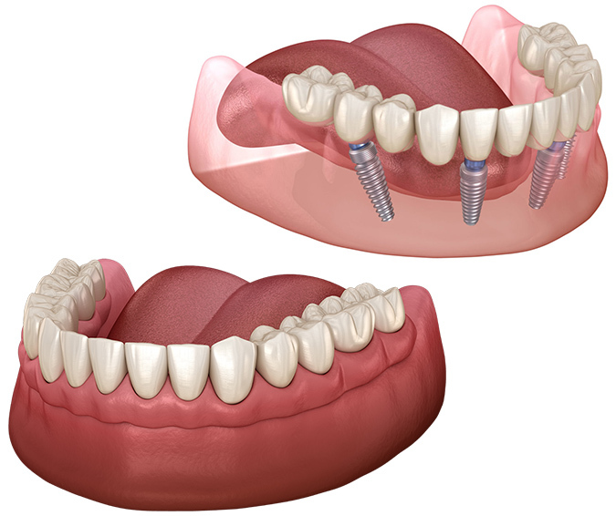 Full mouth dental implants