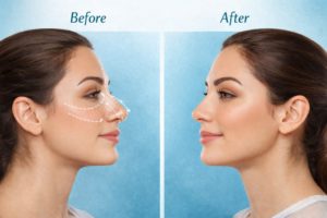 Rhinoplasty Surgery in Hyderabad